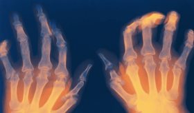 Demencia asociada a artritis reumatoide se relaciona con mayor deterioro cognitivo y mortalidad