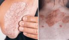 Manejo de la inflamación crónica en la psoriasis: Estrategias probadas para lograr periodos de remisión