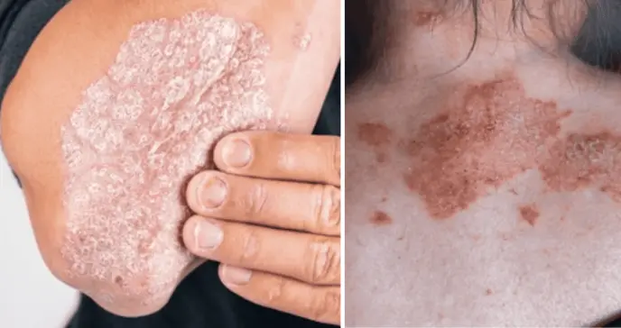 Manejo de la inflamación crónica en la psoriasis: Estrategias probadas para lograr periodos de remisión