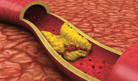 Publican nueva guía de American Association of Clinical Endocrinology para el tratamiento de dislipidemia