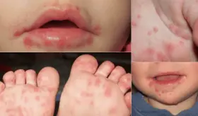 Enfermedad Boca-Mano-Pie es altamente transmisible a través de secreciones orales y fecales