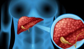 La importancia de estudiar también a las mujeres en la cirrosis hepática