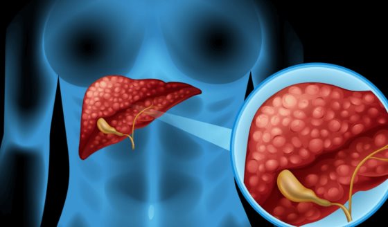 La importancia de estudiar también a las mujeres en la cirrosis hepática
