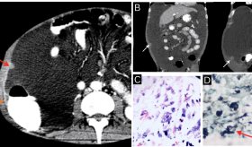 Paciente presenta histoplasmosis peritoneal por inmunosupresión por VIH y enfermedad renal crónica