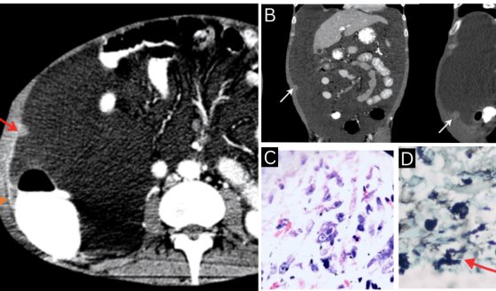 Paciente presenta histoplasmosis peritoneal por inmunosupresión por VIH y enfermedad renal crónica