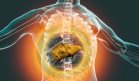 LiverRisk: El avance científico que podría reducir los casos de cirrosis y cáncer de hígado