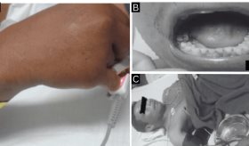 Hombre de 41 años presenta alteraciones hemorrágicas tras contacto con oruga Lonomia sp.