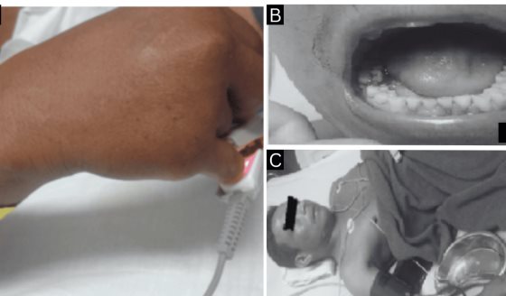 Hombre de 41 años presenta alteraciones hemorrágicas tras contacto con oruga Lonomia sp.