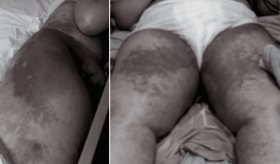 Acrodermatitis enteropática por deficiencia de zinc post-cirugía bariátrica en mujer de 46 años