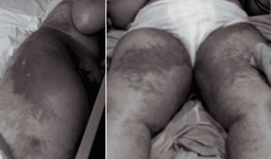 Acrodermatitis enteropática por deficiencia de zinc post-cirugía bariátrica en mujer de 46 años
