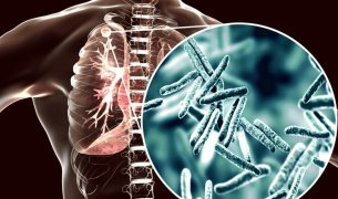 Alerta sobre aumento de casos y muertes por tuberculosis tras la pandemia de COVID-19