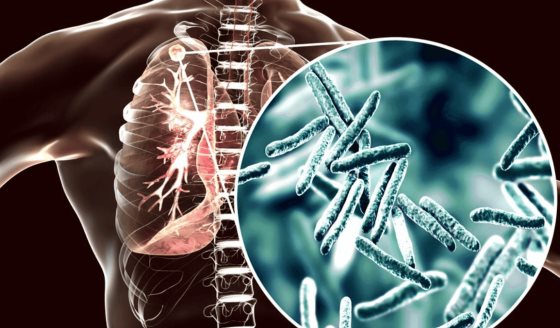 Alerta sobre aumento de casos y muertes por tuberculosis tras la pandemia de COVID-19
