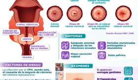CÁNCER DE CUELLO UTERINO