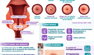 CÁNCER DE CUELLO UTERINO