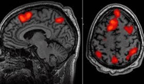 Escáneres de 7T con transmisión paralela optimizan localización de lesiones epilépticas