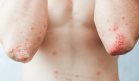 Tratamientos para la psoriasis pustulosa generalizada: corticosteroides, biológicos y nuevas terapias 