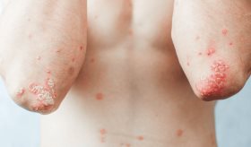 Tratamientos para la psoriasis pustulosa generalizada: corticosteroides, biológicos y nuevas terapias 