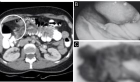 Lipoma colónico como causa inusual de intususcepción en paciente con obstrucción intestinal parcial