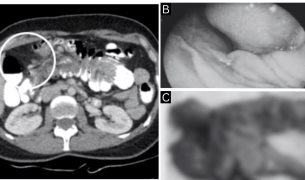 Lipoma colónico como causa inusual de intususcepción en paciente con obstrucción intestinal parcial