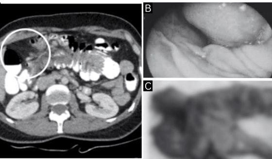 Lipoma colónico como causa inusual de intususcepción en paciente con obstrucción intestinal parcial