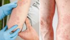 Picor, escamas y enrojecimiento: ¿Cómo saber si es psoriasis, eccema u otro tipo de hongos?