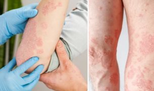 Picor, escamas y enrojecimiento: ¿Cómo saber si es psoriasis, eccema u otro tipo de hongos?