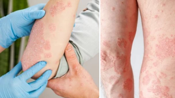 Picor, escamas y enrojecimiento: ¿Cómo saber si es psoriasis, eccema u otro tipo de hongos? Picor, escamas y enrojecimiento: ¿Cómo saber si es psoriasis, eccema u otro tipo de hongos?