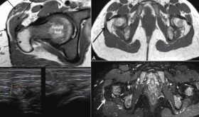 Dolor y chasquido persistente: Síndrome de cadera en resorte con engrosamiento iliotibial tras 3 cirugías