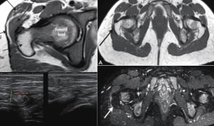 Dolor y chasquido persistente: Síndrome de cadera en resorte con engrosamiento iliotibial tras 3 cirugías