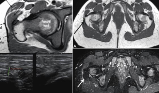 Dolor y chasquido persistente: Síndrome de cadera en resorte con engrosamiento iliotibial tras 3 cirugías