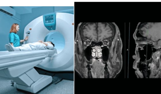 Resonancia magnética mejora selección de pacientes con cáncer de próstata para vigilancia activa: Estudio