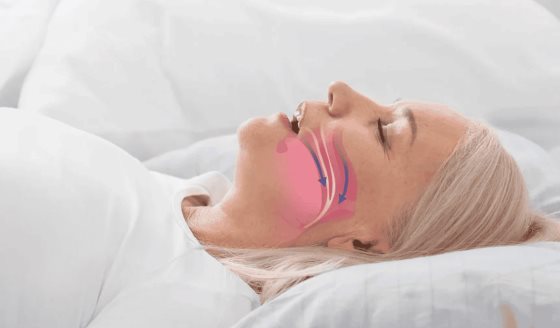 Apnea obstructiva del sueño en mujeres presenta diferencias respecto a los hombres, según estudio