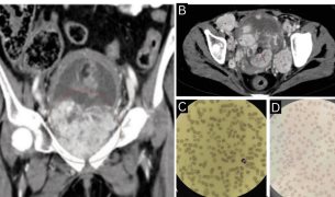 Paciente con feocromocitoma metastásico presentó anemia hemolítica microangiopática paraneoplásica