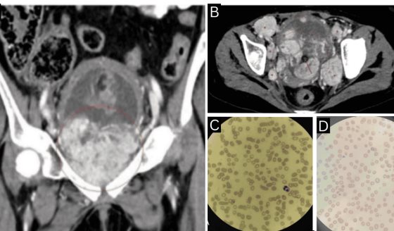 Paciente con feocromocitoma metastásico presentó anemia hemolítica microangiopática paraneoplásica