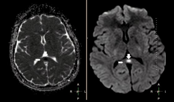 Isquemia en el esplenio del cuerpo calloso como manifestación neurológica de la malaria