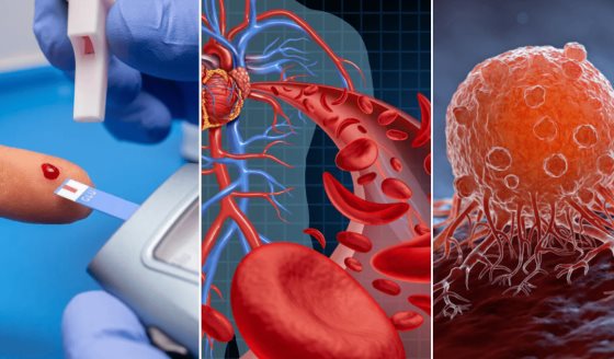 Diabetes tipo 2  y enfermedades cardiovasculares aumentan la mortalidad en pacientes con cáncer