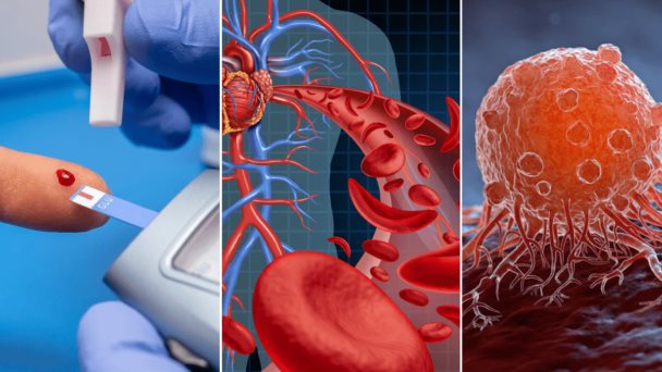 Diabetes tipo 2  y enfermedades cardiovasculares aumentan la mortalidad en pacientes con cáncer