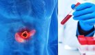 Nuevo análisis de sangre detecta cáncer de páncreas en etapas iniciales con 73% de efectividad