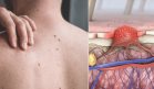 Descubren cómo el melanoma y otros tumores eluden la inmunoterapia mediante la proteína Midkine