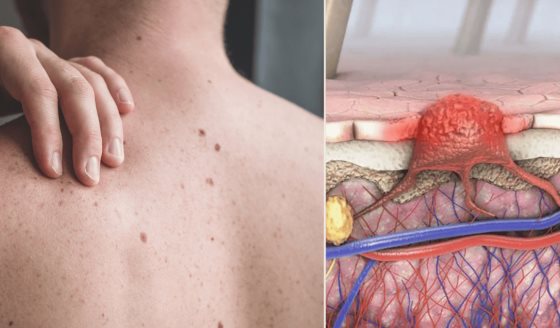 Descubren cómo el melanoma y otros tumores eluden la inmunoterapia mediante la proteína Midkine