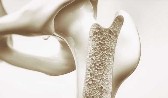 Desarrollan hidrogel inyectable que aumenta densidad ósea y reduce riesgo de fracturas en osteoporosis