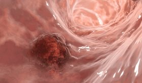 Test no invasivo detecta sangre oculta en las heces optimizando la detección temprana de cáncer de colon