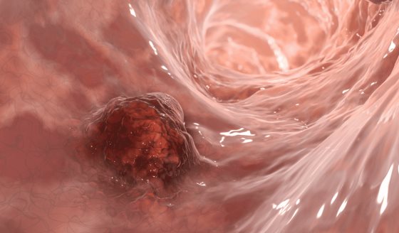 Test no invasivo detecta sangre oculta en las heces optimizando la detección temprana de cáncer de colon