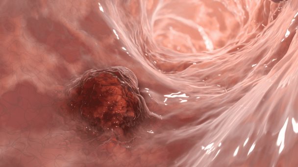 Test no invasivo detecta sangre oculta en las heces optimizando la detección temprana de cáncer de colon Test no invasivo detecta sangre oculta en las heces optimizando la detección temprana de cáncer de colon