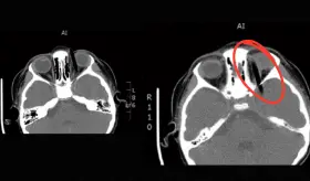 Vómitos y hematoma ocular: Equipo médico extrae pincel de 14 cm alojado en la órbita de niña de 5 años