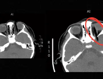 Vómitos y hematoma ocular: Equipo médico extrae pincel de 14 cm alojado en la órbita de niña de 5 años