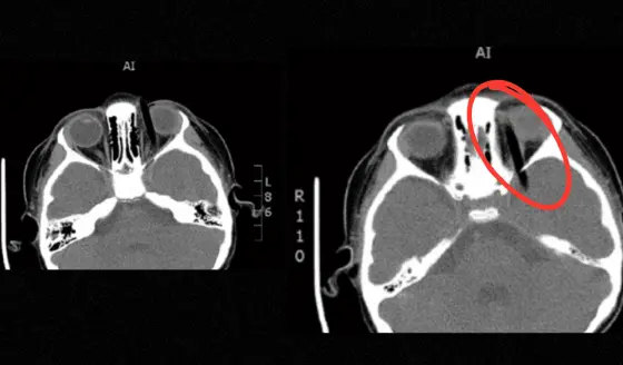 Vómitos y hematoma ocular: Equipo médico extrae pincel de 14 cm alojado en la órbita de niña de 5 años