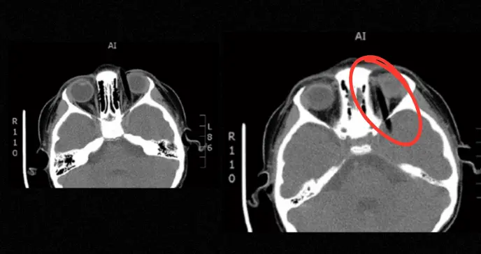 Vómitos y hematoma ocular: Equipo médico extrae pincel de 14 cm alojado en la órbita de niña de 5 años