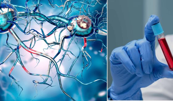 Desarrollan un test de sangre que diagnostica el alzhéimer y mide el grado de demencia
