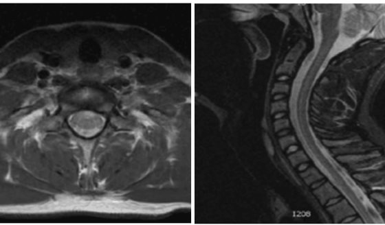 Paciente pediátrico en remisión de linfoma de hodgkin desarrolló neuromielitis óptica